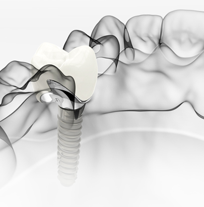 Dental Implants - Gloucester Street Dental